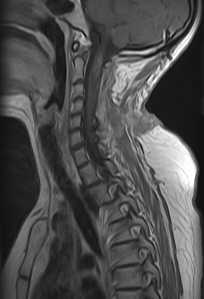 File:Astrocytoma - spinal cord (Radiopaedia 69769-79758 Sagittal T1 C+ 5).jpg