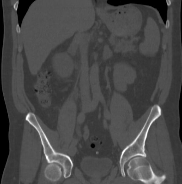 File:Atrophic kidney due to severe chronic obstructive hydronephrosis (Radiopaedia 40828-43474 Coronal bone window 1).jpg
