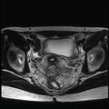 Atypical deep infiltrating endometriosis (Radiopaedia 44470-48125 Axial T2 18).jpg