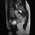 Atypical deep infiltrating endometriosis (Radiopaedia 44470-48125 Sagittal T2 5).jpg