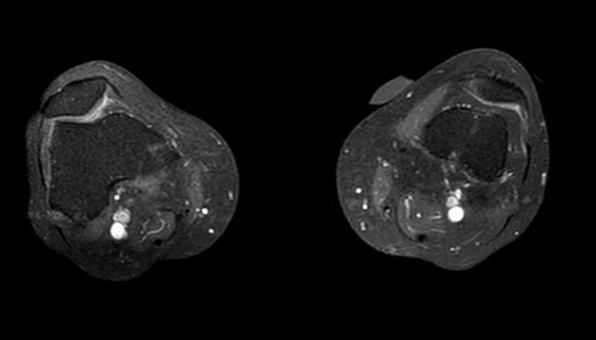 Atypical lipomatous tumor - thigh (Radiopaedia 68975-78734 Axial T1 C+ fat sat 14).jpg