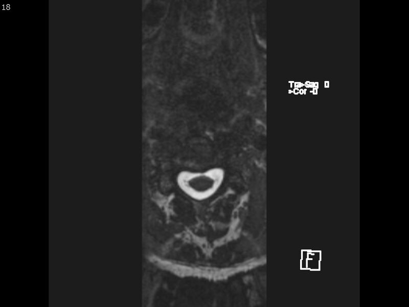 File:Atypical meningioma - intraosseous (Radiopaedia 64915-74572 Axial CISS 18).jpg