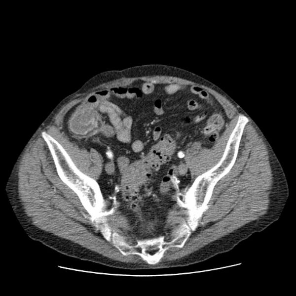 File:Autosomal dominant polycystic kidney disease (Radiopaedia 27851-28094 B 103).jpg