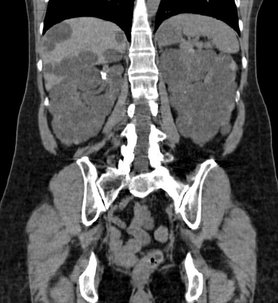 File:Autosomal dominant polycystic kidney disease (Radiopaedia 41918-44922 Coronal non-contrast 34).jpg