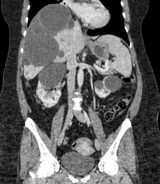 File:Autosomal dominant polycystic kidney disease (Radiopaedia 57124-64017 B 41).jpg