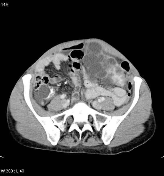 File:Autosomal dominant polycystic kidney disease with extensive hepatic involvement (Radiopaedia 5204-6971 B 21).jpg