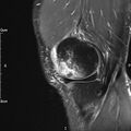 Avulsion fracture of the fibular head (Radiopaedia 74804-85808 Sagittal PD fat sat 8).jpg