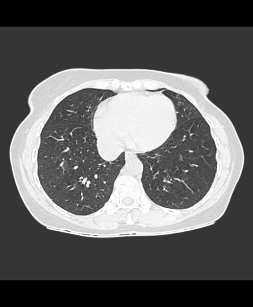 File:Azygos fissure and azygos lobe (Radiopaedia 41841-44832 Axial lung window 4).jpg