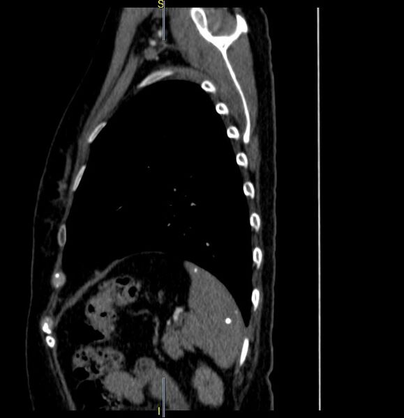 File:Azygos vein aneurysm (Radiopaedia 77824-90130 D 7).JPG