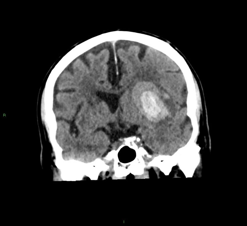 Basal ganglia hemorrhage (Radiopaedia 58791-66025 Coronal non-contrast 37).jpg