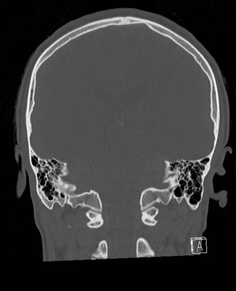 File:Base of skull fracture with bilateral Le Fort fractures (Radiopaedia 47094-51638 Coronal bone window 36).jpg