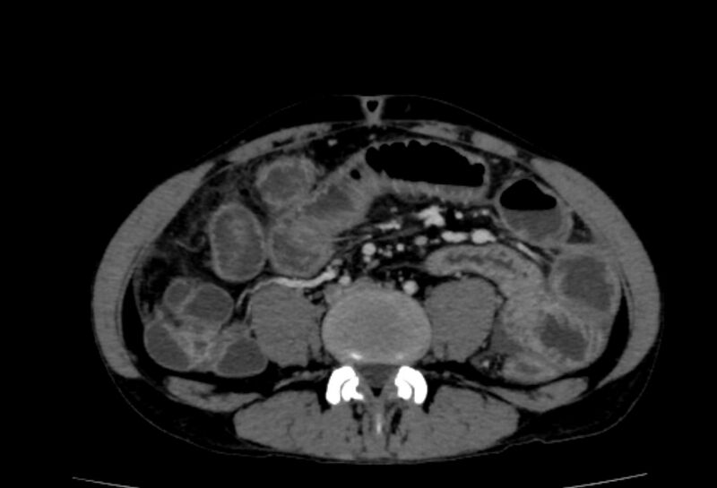 File:Behçet's disease- abdominal vasculitis (Radiopaedia 55955-62570 A 52).jpg