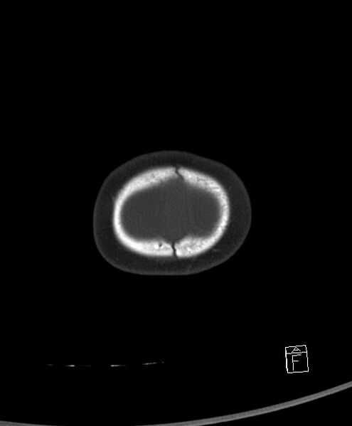 File:Benign enlargement of subarachnoid spaces in infancy (BESS) (Radiopaedia 87459-103795 Axial bone window 2).jpg