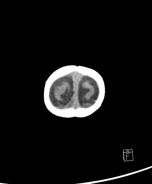 File:Benign enlargement of subarachnoid spaces in infancy (BESS) (Radiopaedia 87459-103795 Axial non-contrast 3).jpg