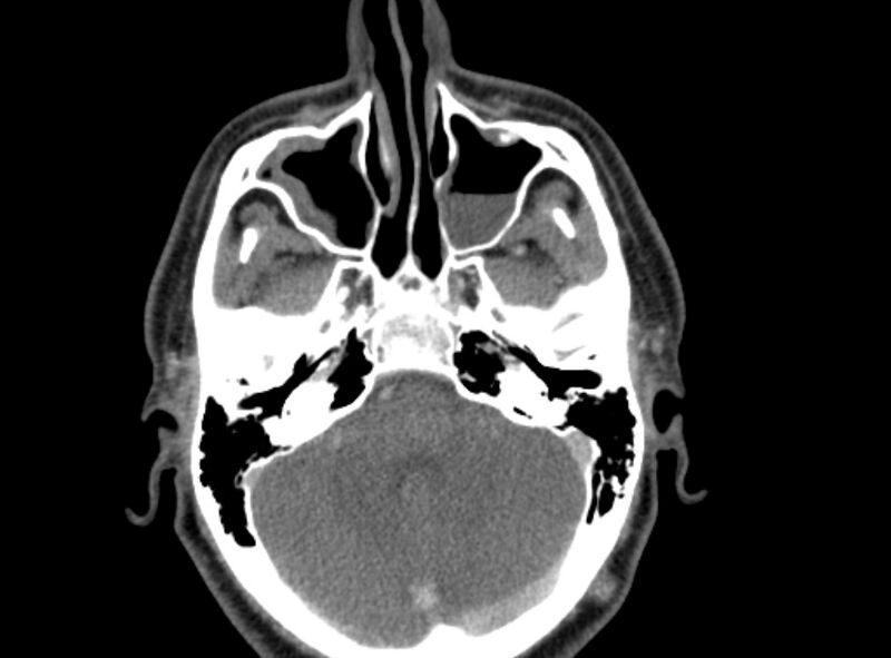File:Benign mixed salivary tumor of the parotid gland (Radiopaedia 35261-36792 A 8).jpg