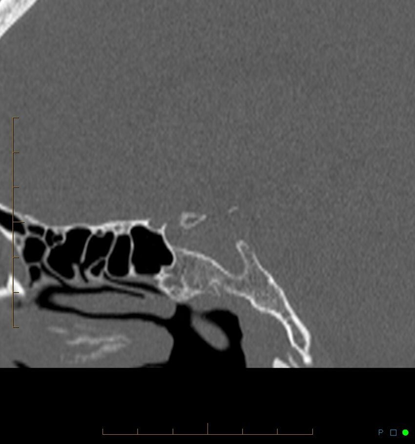 Benign notochordal cell tumor (probable) (Radiopaedia 65475-74546 Sagittal bone window 34).jpg