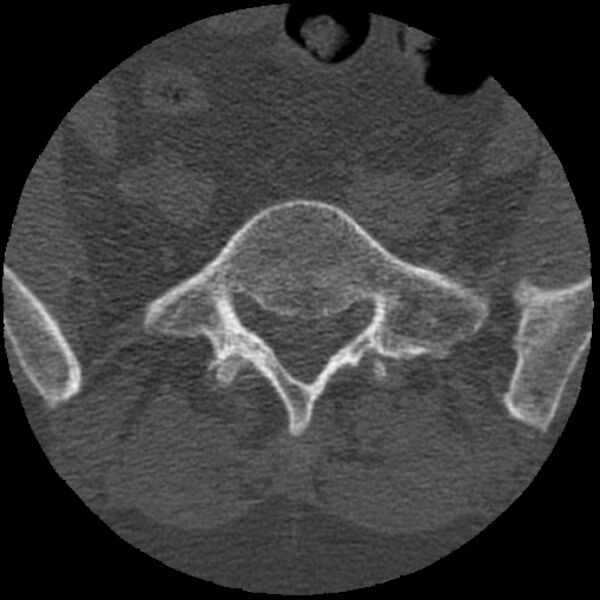 File:Bertolotti syndrome (Radiopaedia 24864-25128 Axial bone window 14).jpg