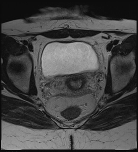 File:Bicornuate, unicollis uterus (Radiopaedia 79468-92593 Axial T2 14).jpg