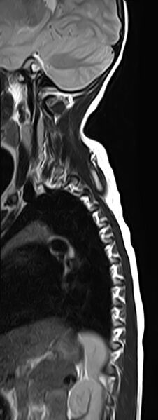 File:Bilateral Sprengel deformity with Klippel-Feil syndrome (Radiopaedia 66395-75650 Sagittal T2 12).jpg