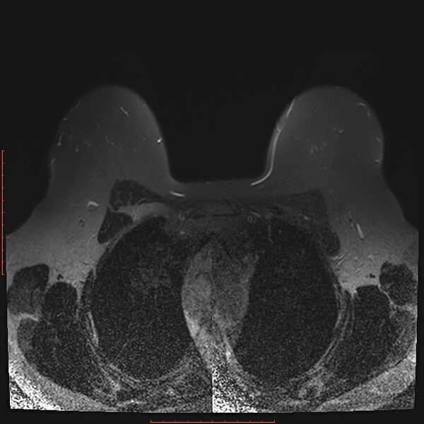 File:Bilateral breast implant rupture (Radiopaedia 24761-25027 T2 fat sat 10).jpg