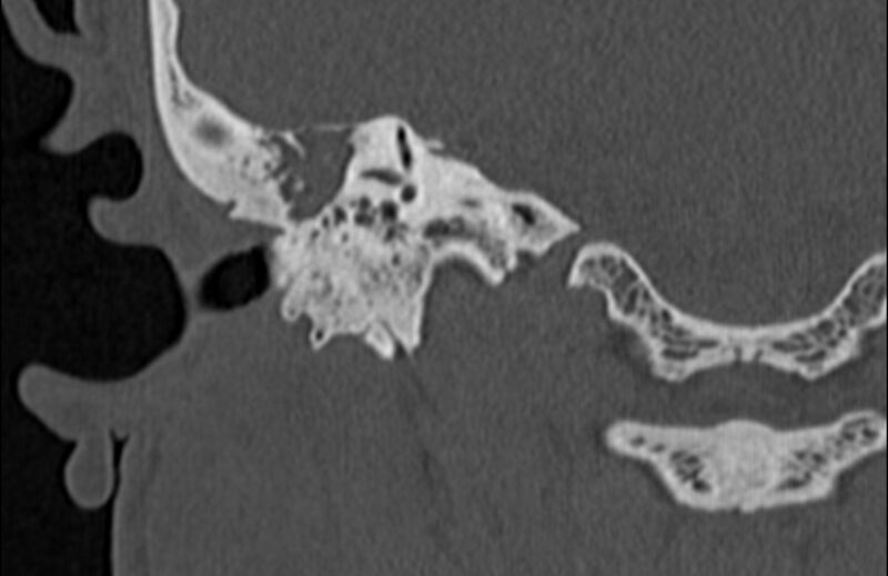 File:Bilateral cholesteatoma (Radiopaedia 54898-61172 Coronal bone window 48).jpg
