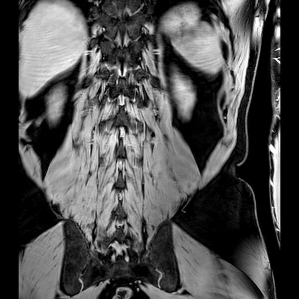 File:Bilateral conjoined nerve roots at different levels (Radiopaedia 73312-84063 B 41).jpg