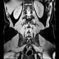 Bilateral conjoined nerve roots at different levels (Radiopaedia 73312-84063 Coronal WE 39).jpg