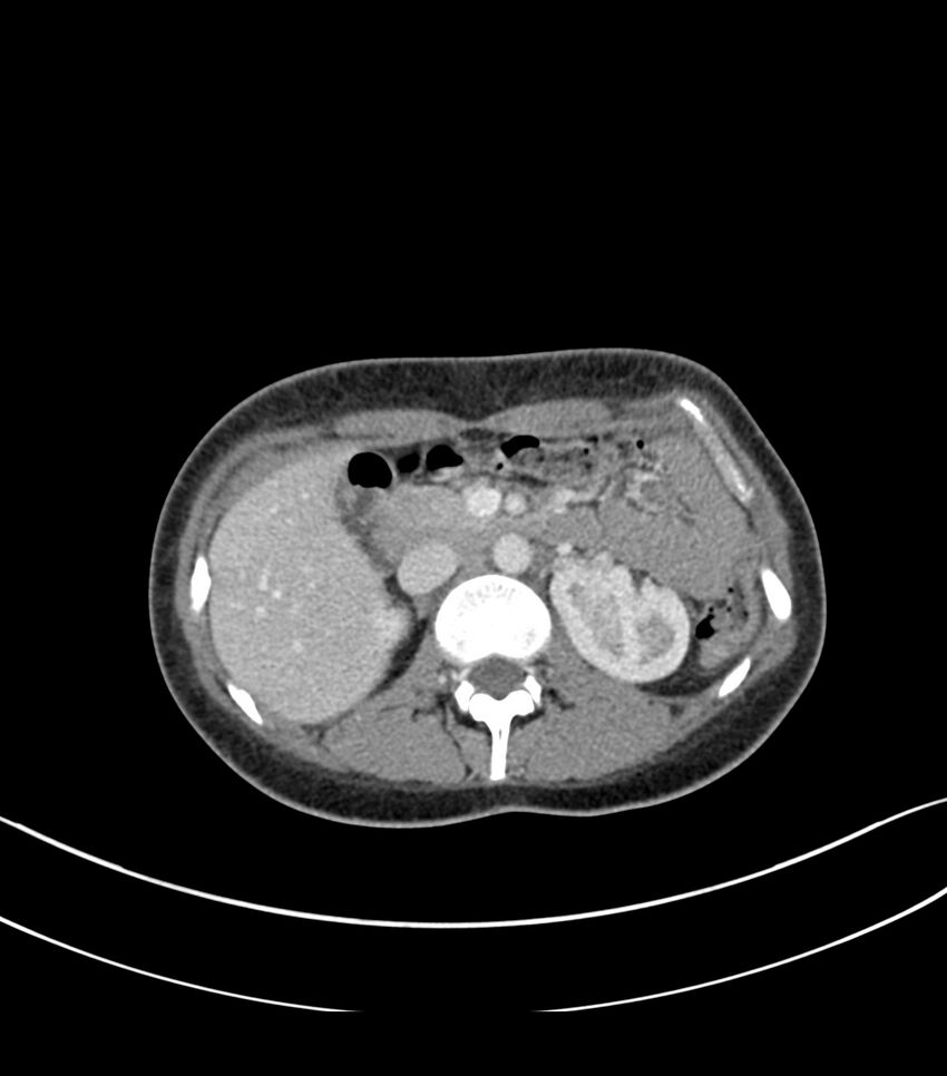 Bilateral kidney malrotation (Radiopaedia 72227-82749 A 15).jpg