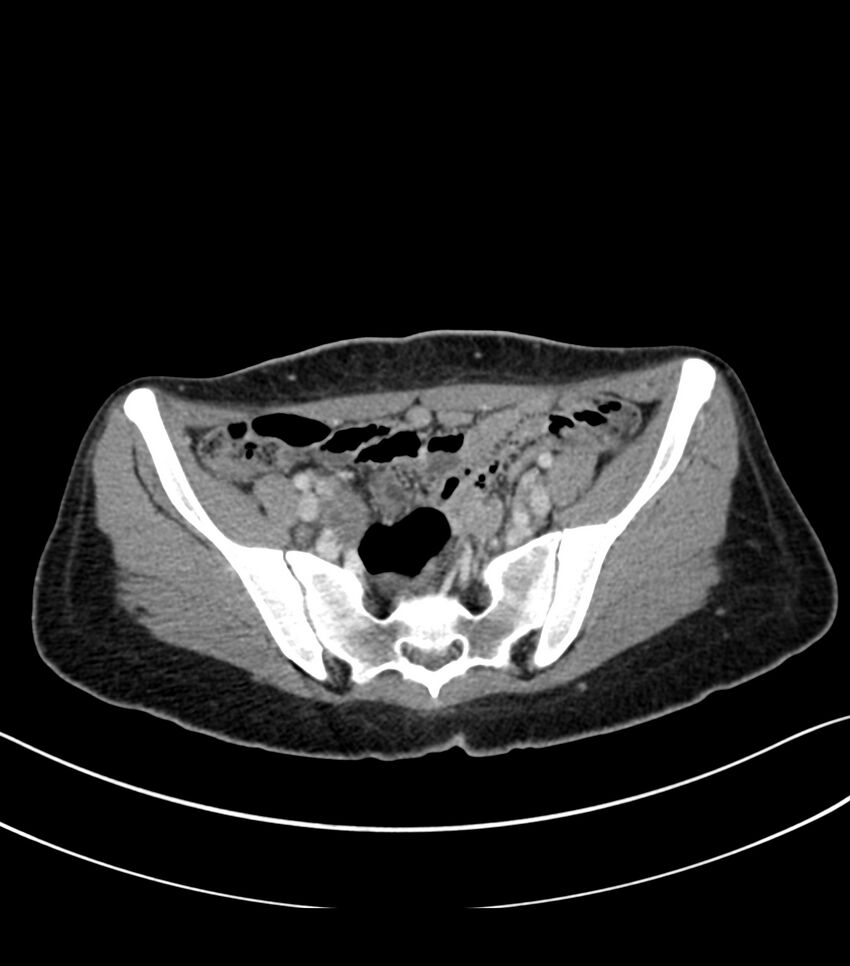 Bilateral kidney malrotation (Radiopaedia 72227-82749 A 54).jpg