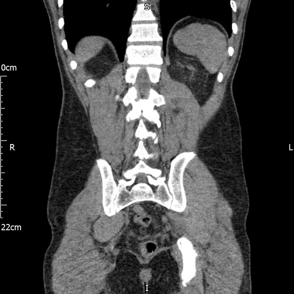 File:Bilateral medullary nephrocalcinosis with ureteric calculi (Radiopaedia 71269-81569 Coronal non-contrast 56).jpg