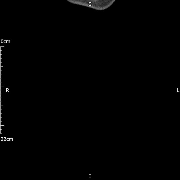 File:Bilateral medullary nephrocalcinosis with ureteric calculi (Radiopaedia 71269-81569 Coronal non-contrast 87).jpg