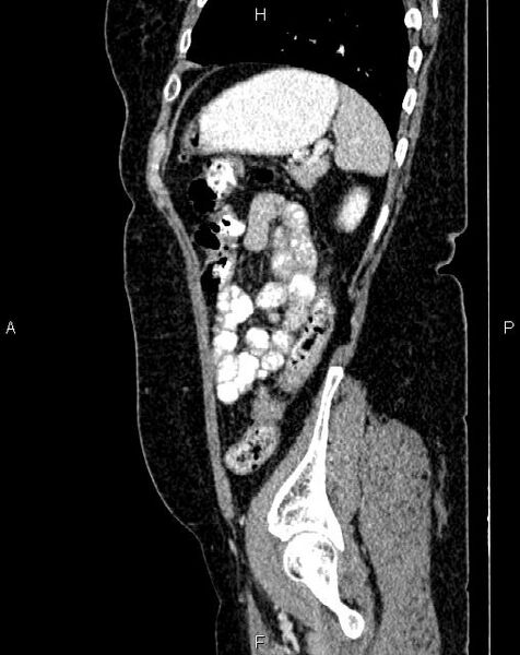 File:Bilateral ovarian serous cystadenocarcinoma (Radiopaedia 86062-101989 E 71).jpg