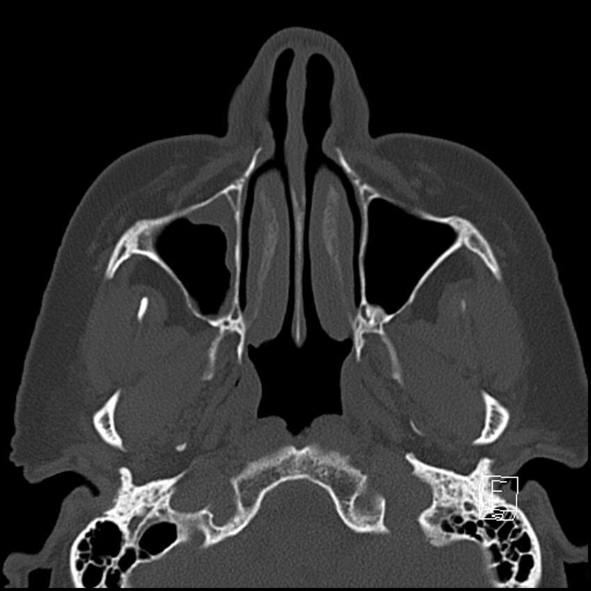 Bilateral palatine tonsilloliths on OPG and CT (Radiopaedia 75167-86247 Axial bone window 24).jpg