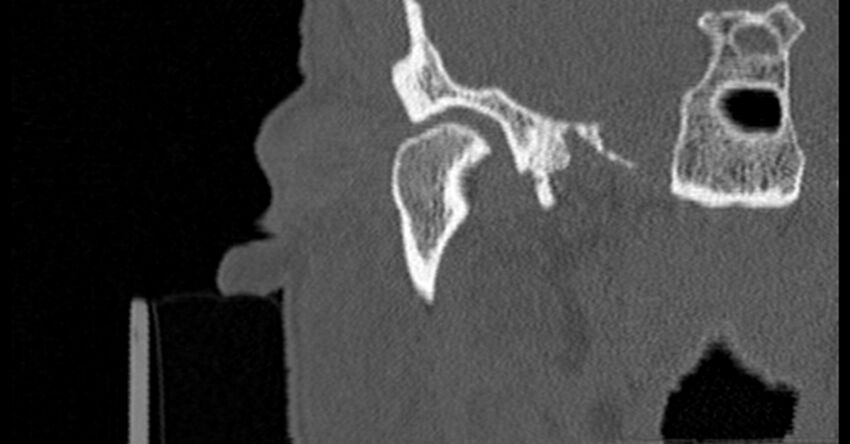 Bilateral temporal bone fractures (Radiopaedia 29482-29970 Coronal non-contrast 51).jpg