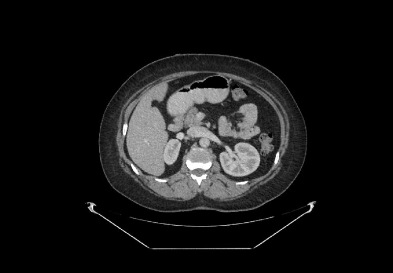 File:Bilateral urolithiasis with incidentally detected splenic artery aneurysm and left inferior vena cava (Radiopaedia 44467-48127 B 30).jpg