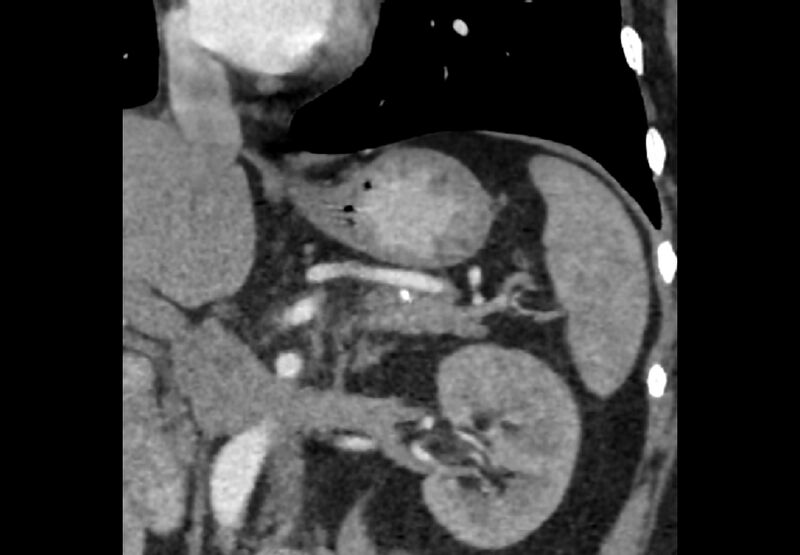 File:Bilateral urolithiasis with incidentally detected splenic artery aneurysm and left inferior vena cava (Radiopaedia 44467-48127 Ob. Cor. C+ Art. 20).jpg