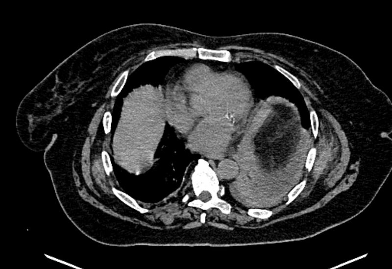 File:Biliary pancreatitis (Radiopaedia 72289-82823 Axial non-contrast 15).jpg