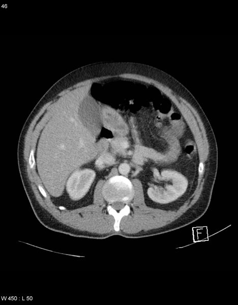 File:Boerhaave syndrome with tension pneumothorax (Radiopaedia 56794-63603 A 23).jpg