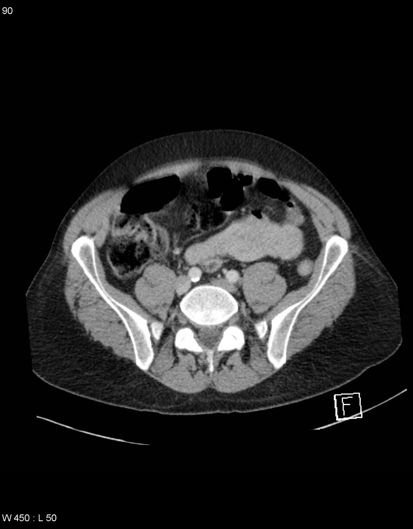 Boerhaave syndrome with tension pneumothorax (Radiopaedia 56794-63603 A 45).jpg