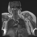 Brachial plexopathy (Radiopaedia 21844-21806 Coronal T1 C+ 10).jpg
