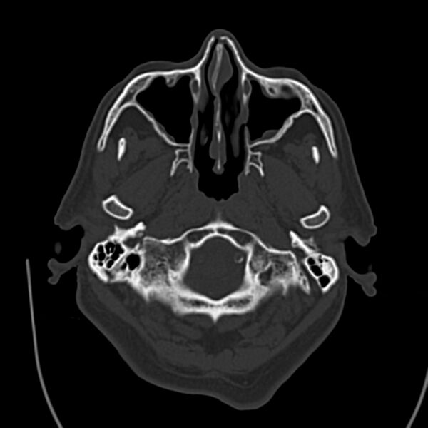File:Brain Pantopaque remnants (Radiopaedia 78403-91048 Axial bone window 15).jpg