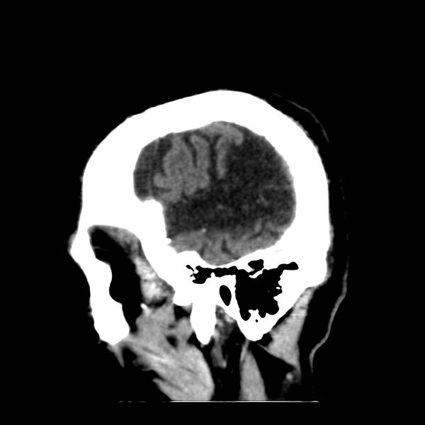 File:Brain Pantopaque remnants (Radiopaedia 78403-91048 C 8).jpg