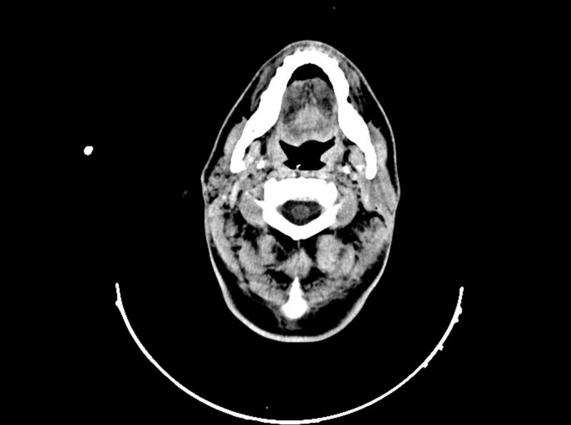 File:Brain injury by firearm projectile (Radiopaedia 82068-96088 A 49).jpg