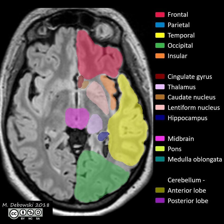 Brain lobes - annotated MRI (Radiopaedia 61691-69700 Axial 42).JPG