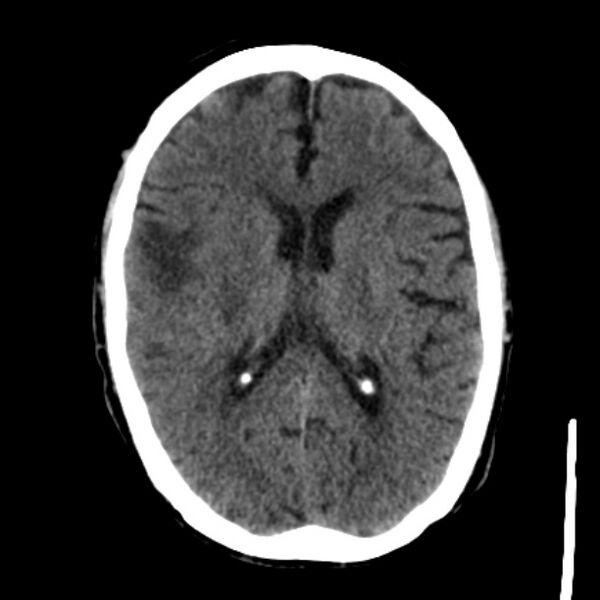 File:Brain metastases from lung cancer (Radiopaedia 27849-28092 Axial non-contrast 26).jpg