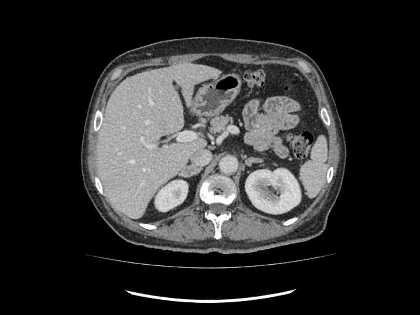 Brain metastases from renal cell carcinoma (Radiopaedia 42222-45328 B 41).jpg