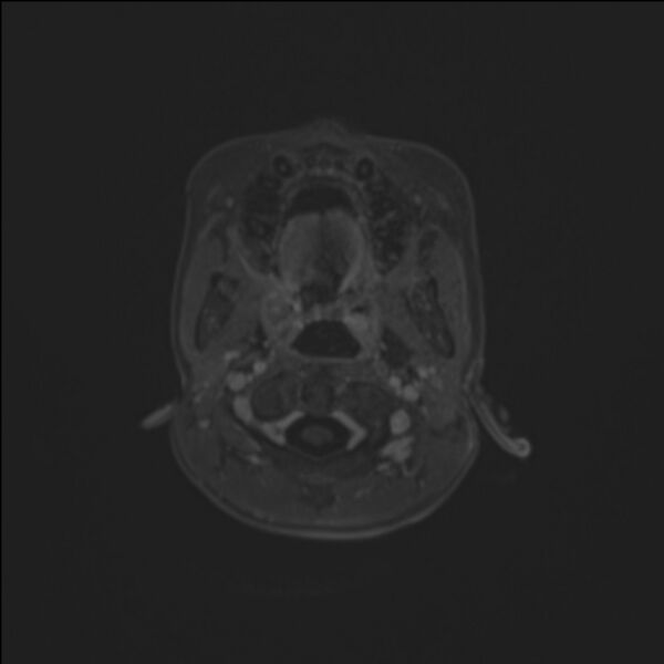 File:Brainstem glioma (Radiopaedia 70548-80674 Axial T1 C+ 8).jpg