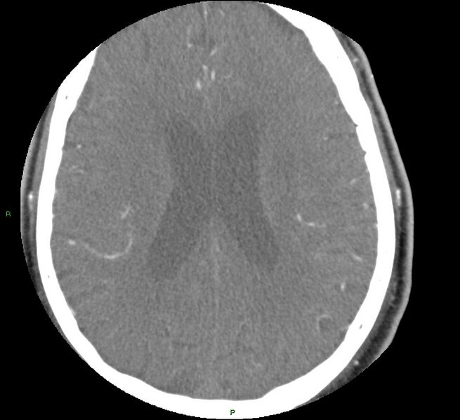 File:Brainstem hemorrhage (Radiopaedia 58794-66028 D 122).jpg