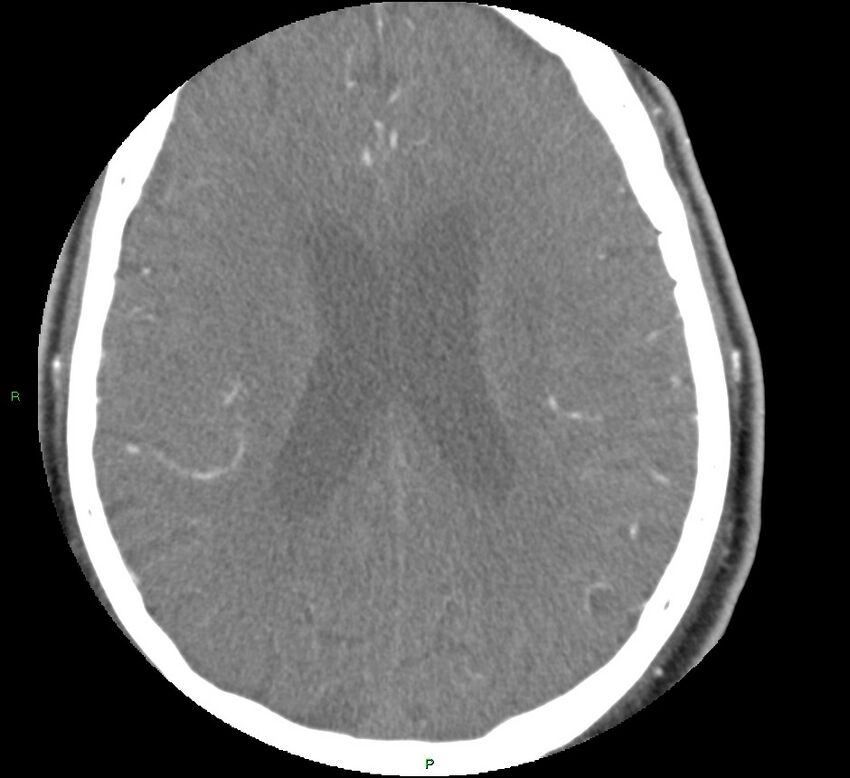 Brainstem hemorrhage (Radiopaedia 58794-66028 D 122).jpg