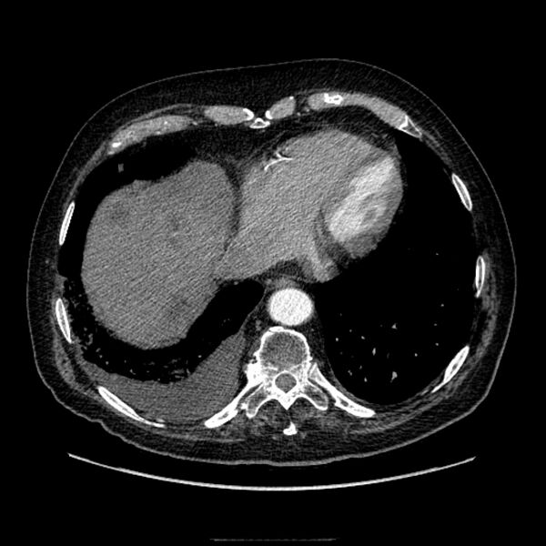 File:Bronchogenic adenocarcinoma and pulmonary embolism (Radiopaedia 9097-9806 D 46).jpg